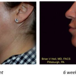 Facelift Before and After