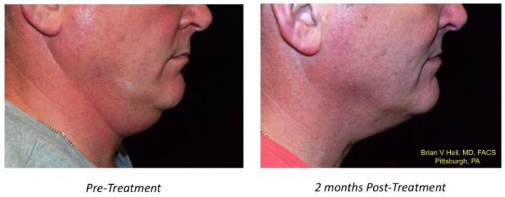Facelift Before and After