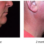 Facelift Before and After
