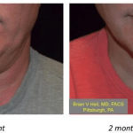 Facelift Before and After