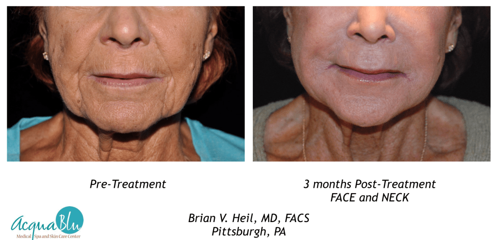 Facelift Before and After