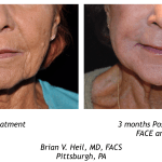 Facelift Before and After