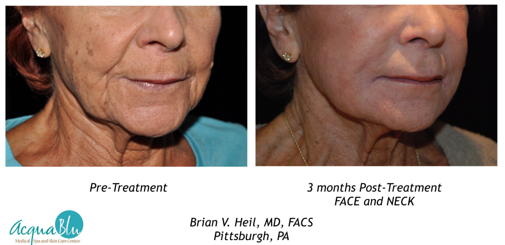 Facelift Before and After
