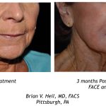 Facelift Before and After