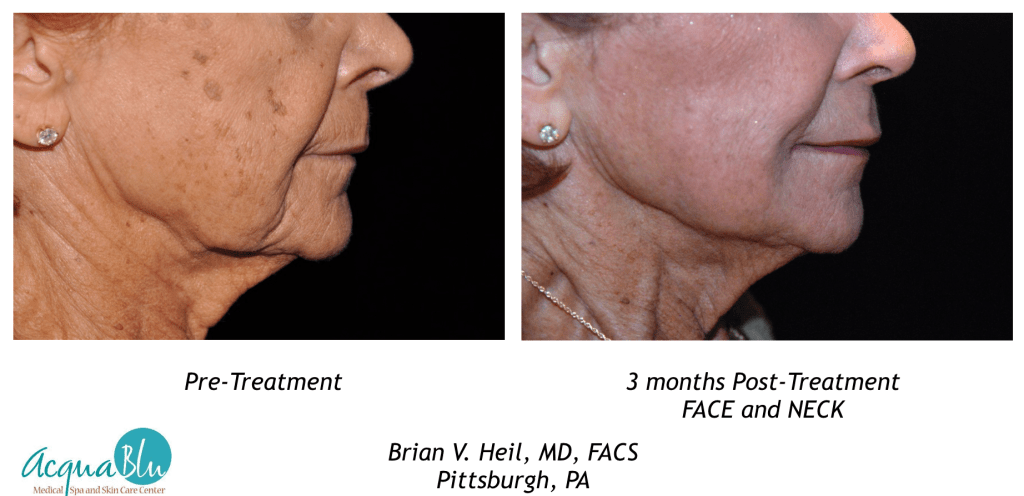 Facelift Before and After