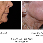 Facelift Before and After