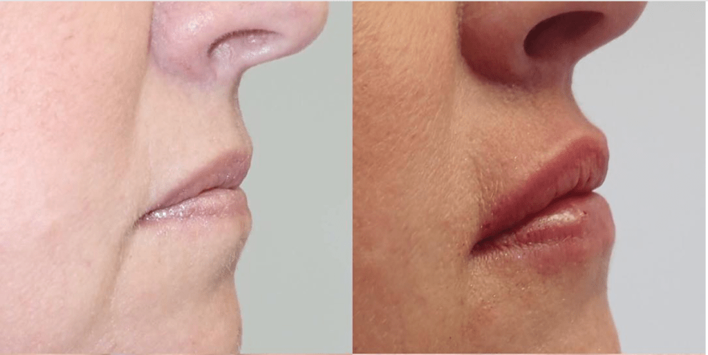 Side view of before and after lip augmentation