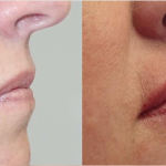 Side view of before and after lip augmentation