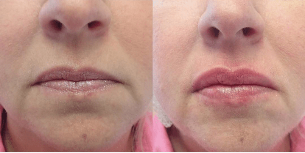 Front view of before and after lip augmentation