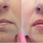 Front view of before and after lip augmentation