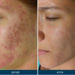 Microneedling PRP