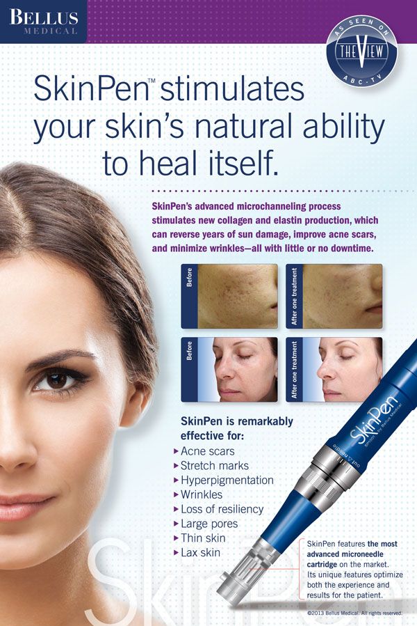 Microneedling PRP