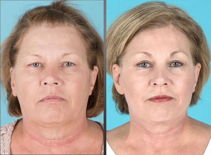 before and after brow lift, eyelid lift, facelift, neck lift, and laser resurfacing
