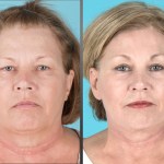before and after brow lift, eyelid lift, facelift, neck lift, and laser resurfacing