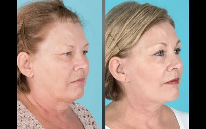 before and after brow lift, eyelid lift, facelift, neck lift, and laser resurfacing