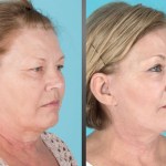 before and after brow lift, eyelid lift, facelift, neck lift, and laser resurfacing