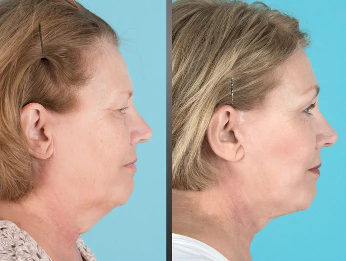 before and after brow lift, eyelid lift, facelift, neck lift, and laser resurfacing