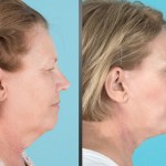 before and after brow lift, eyelid lift, facelift, neck lift, and laser resurfacing