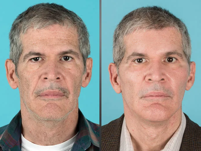Front view of before and after cosmetic surgery for men