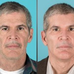 Front view of before and after cosmetic surgery for men