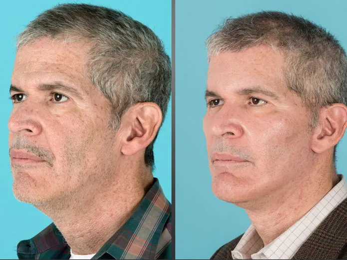 Before and after cheek implants