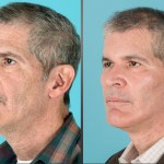 Before and after cheek implants