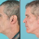 Before and after cheek implants