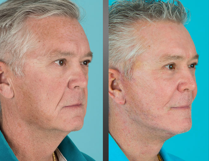 Before and after cheek implants