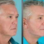 Before and after cheek implants