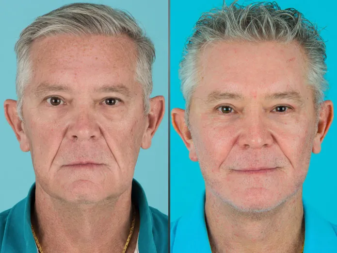 Before and after Eyelid Lift, Facelift, Neck Lift, Cheek implant, and laser resurfacing