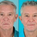 Before and after Eyelid Lift, Facelift, Neck Lift, Cheek implant, and laser resurfacing
