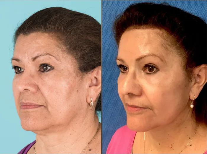Before and after Eyelid Lift, Facelift, Neck Lift, Cheek implant