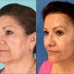 Before and after Eyelid Lift, Facelift, Neck Lift, Cheek implant