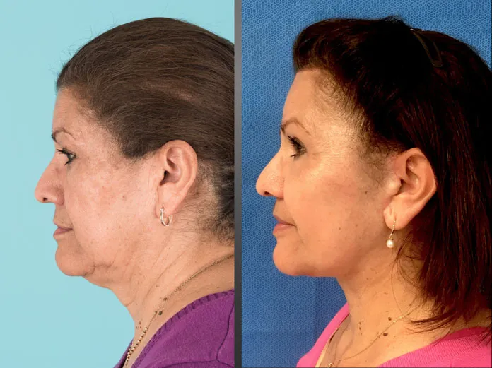 Before and after Eyelid Lift, Facelift, Neck Lift, Cheek implant