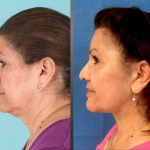 Before and after Eyelid Lift, Facelift, Neck Lift, Cheek implant