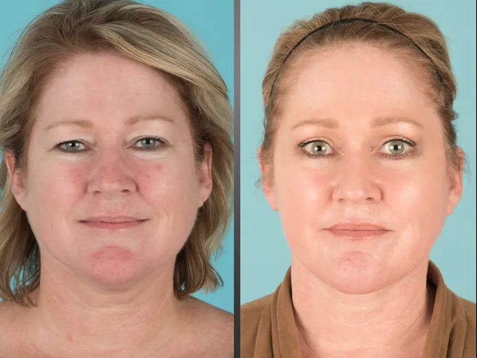 Before and after Eyelid Lift, Facelift, Neck Lift, Fat transfer, and laser resurfacing