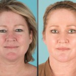 Before and after Eyelid Lift, Facelift, Neck Lift, Fat transfer, and laser resurfacing