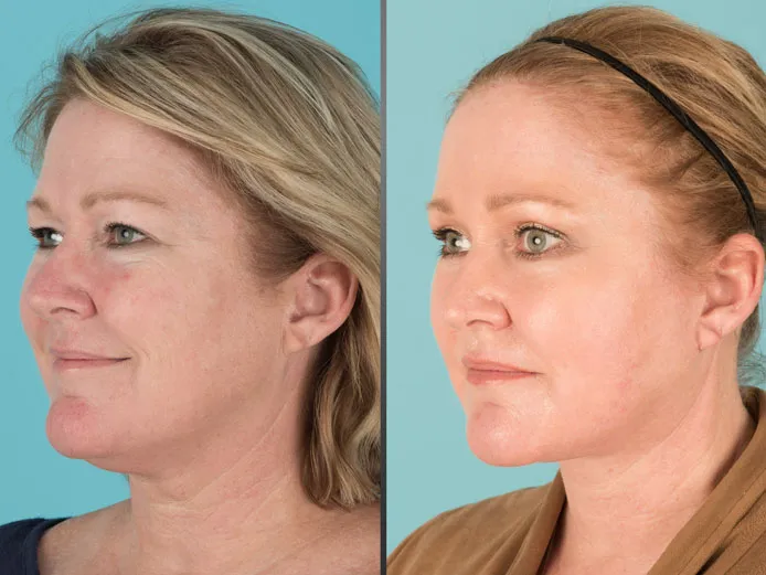 Before and after Eyelid Lift, Facelift, Neck Lift, Fat transfer, and laser resurfacing