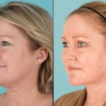 Before and after Eyelid Lift, Facelift, Neck Lift, Fat transfer, and laser resurfacing
