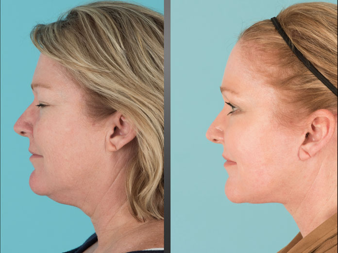 Before and after Eyelid Lift, Facelift, Neck Lift, Fat transfer, and laser resurfacing