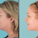 Before and after Eyelid Lift, Facelift, Neck Lift, Fat transfer, and laser resurfacing