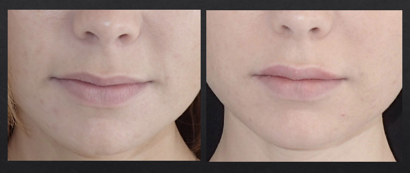 Front view of before and after lip augmentation