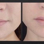 Front view of before and after lip augmentation