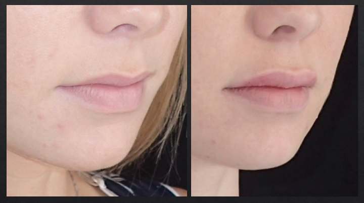 Before and after lip augmentation