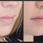 Before and after lip augmentation