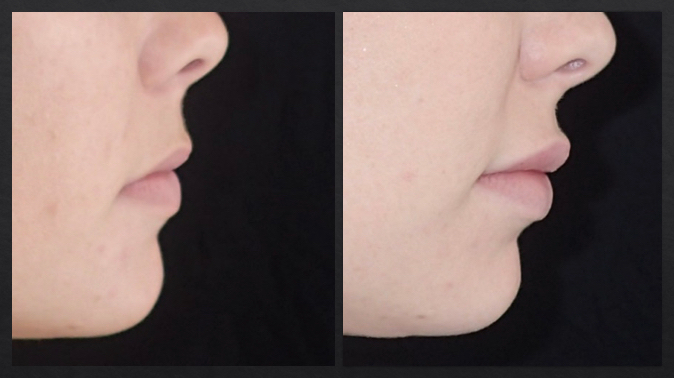 Side view of before and after lip augmentation