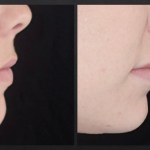 Side view of before and after lip augmentation