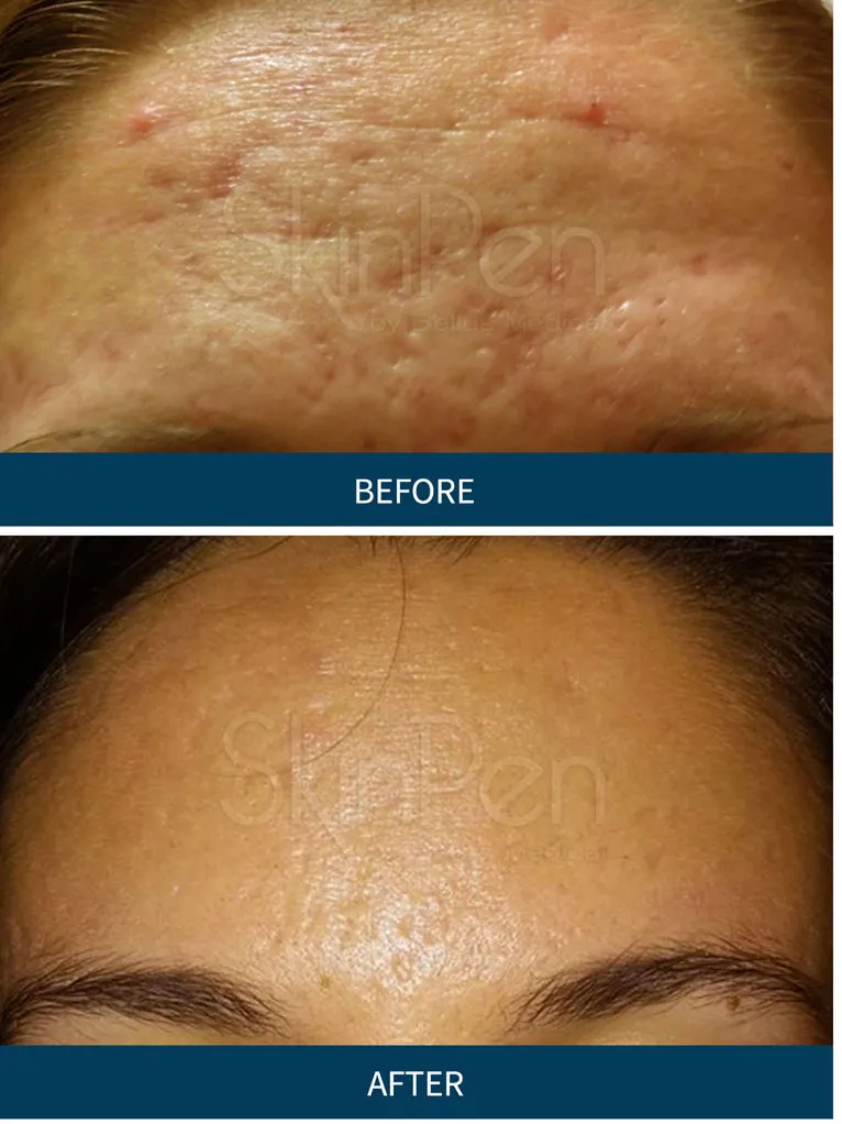 Microneedling PRP