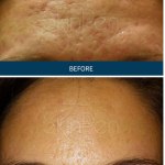 Microneedling PRP