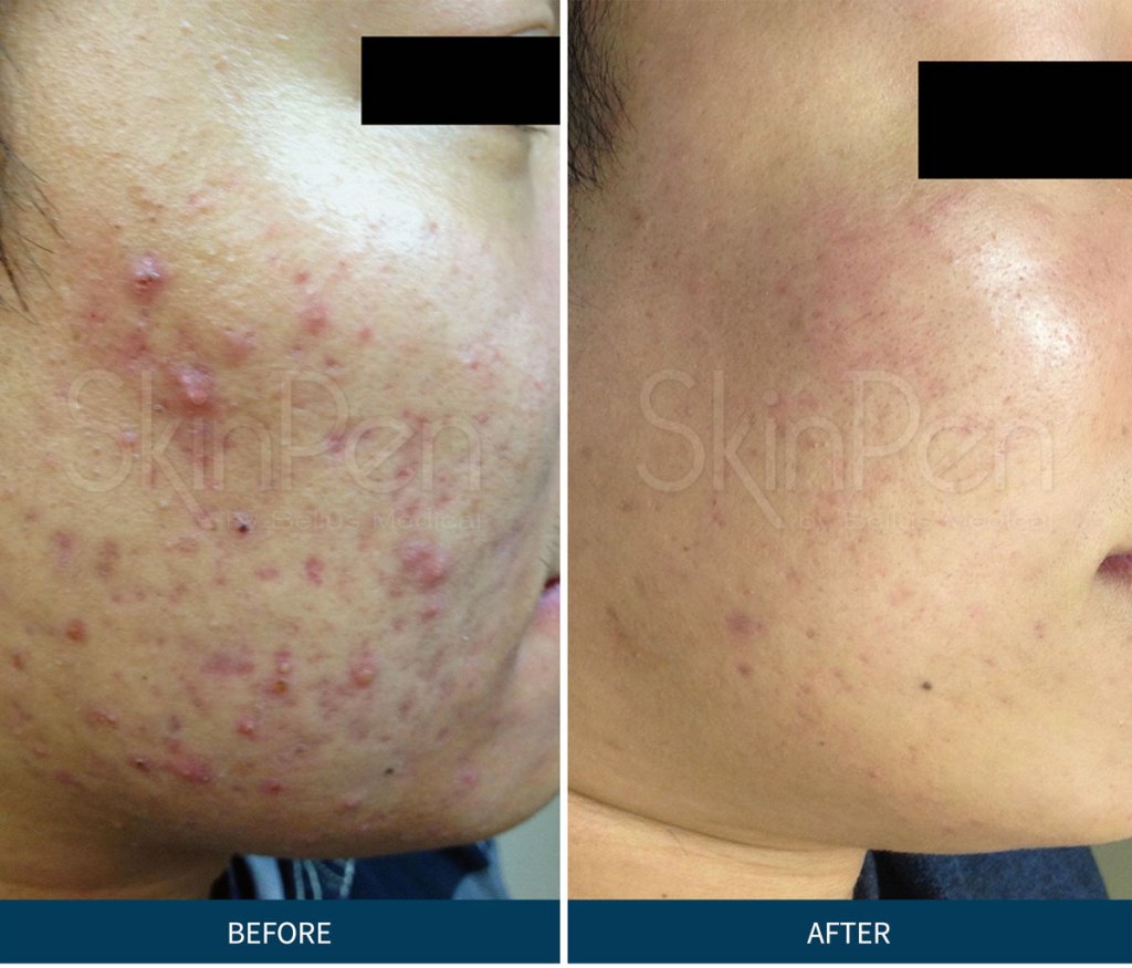 Microneedling PRP